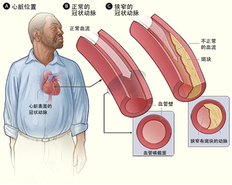什么是冠心病?(图1) 什么是冠心病?(图1)