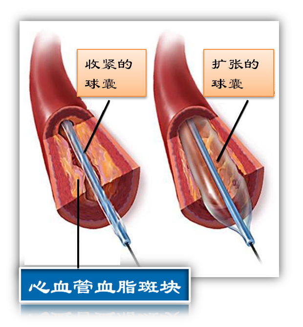 什么是球囊?(图1) 什么是球囊?(图1)