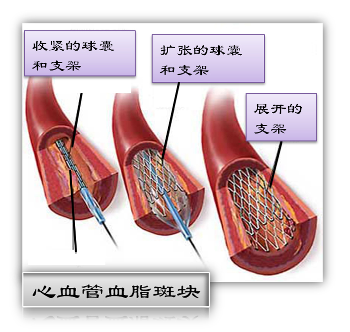 什么是支架?(图1) 什么是支架?(图1)