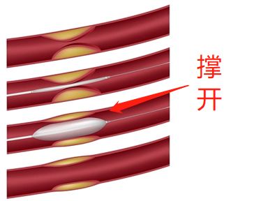 什么是药物球囊?(图2) 什么是药物球囊?(图2)